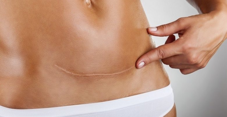 Przeszkadzają Ci blizny? Można je rehabilitować! Zajmują się tym specjaliści z Piekarskiego Centrum Medycznego