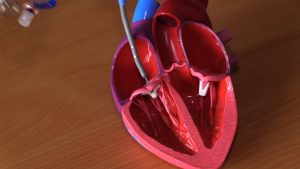 Śląscy kardiolodzy dokonali cudu! Takiej operacji serca jeszcze nikt nie przeprowadził!